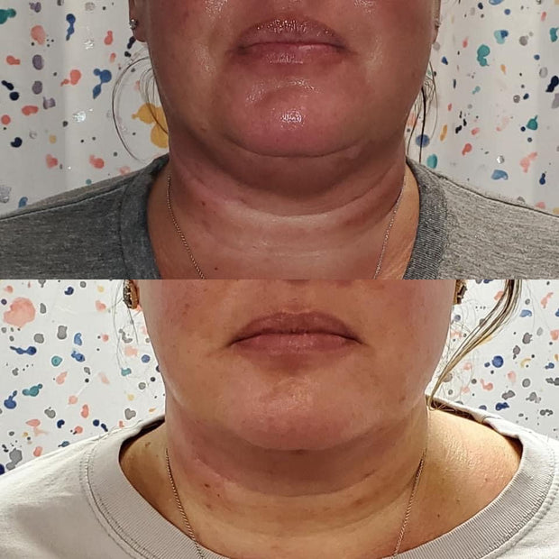 Double Chin Reduction